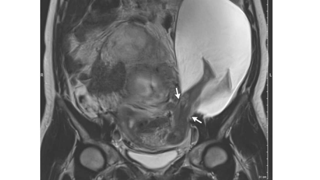 Bebê rompe útero e coloca pernas para fora