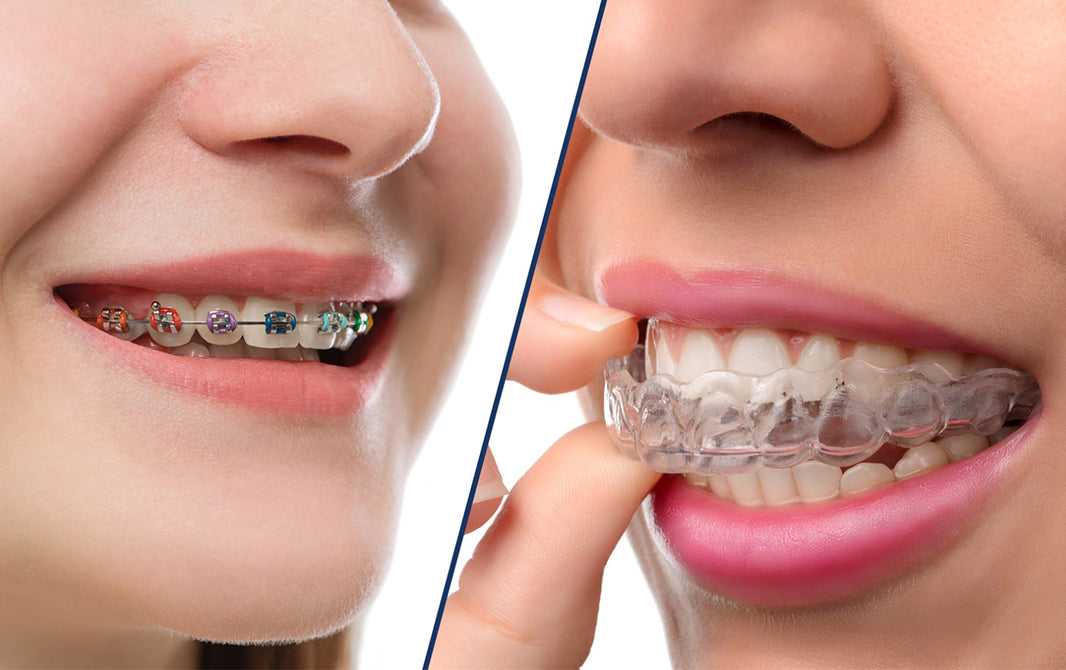 Invisalign: por que adolescentes têm optado por esse aparelho invisível?