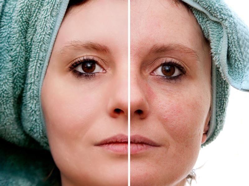 Previna e trate o melasma