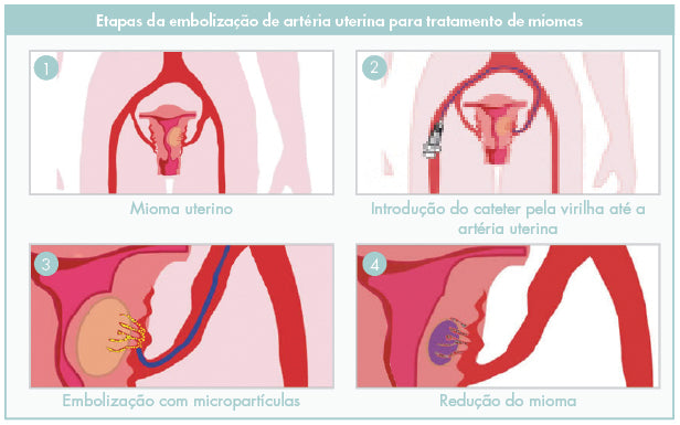 Como tratar miomas sem perder o útero