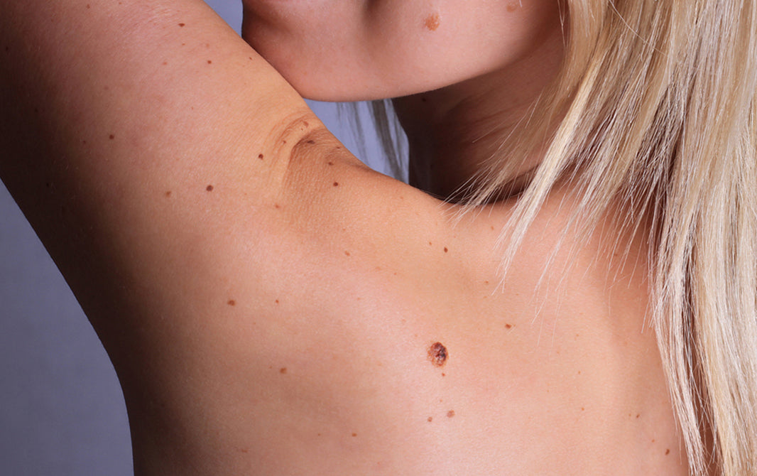 Pintinhas de pele na gravidez: devo me preocupar?