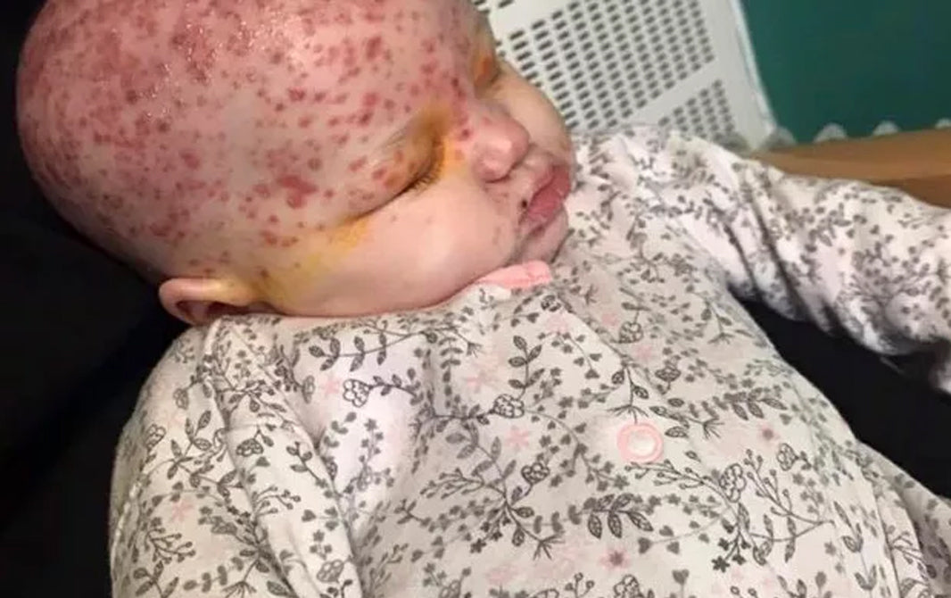 Mãe compartilha foto de filha com herpes para conscientizar sobre visitas