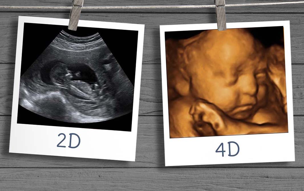 Por que vale a pena fazer um ultrassom 4D na gestação?