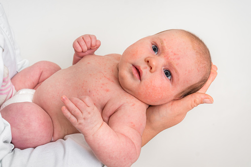 Como prevenir alergias comuns na pele do bebê?