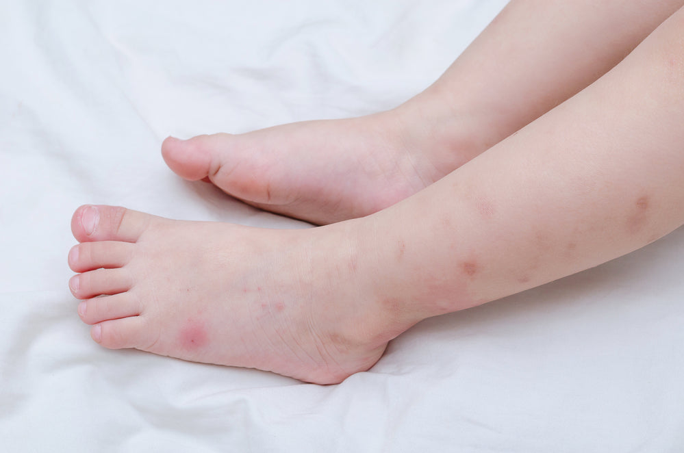 Seu filho tem alergia à picada de insetos?