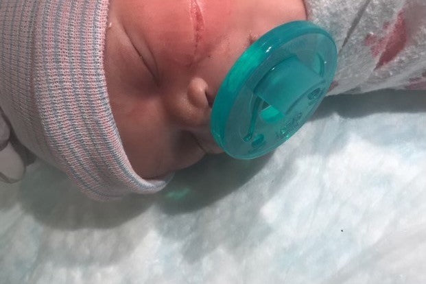 Bebê tem rosto cortado durante cesárea de emergência